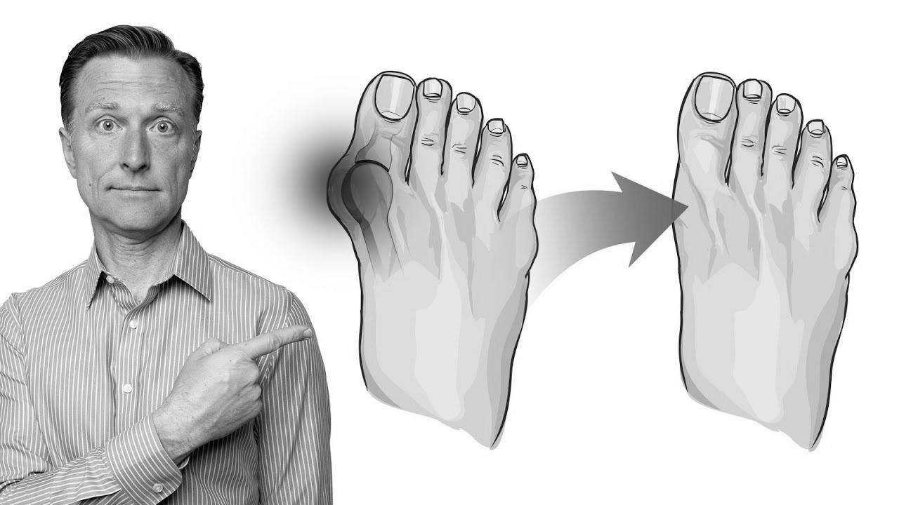The best way to Fix Bunions in 3 Steps