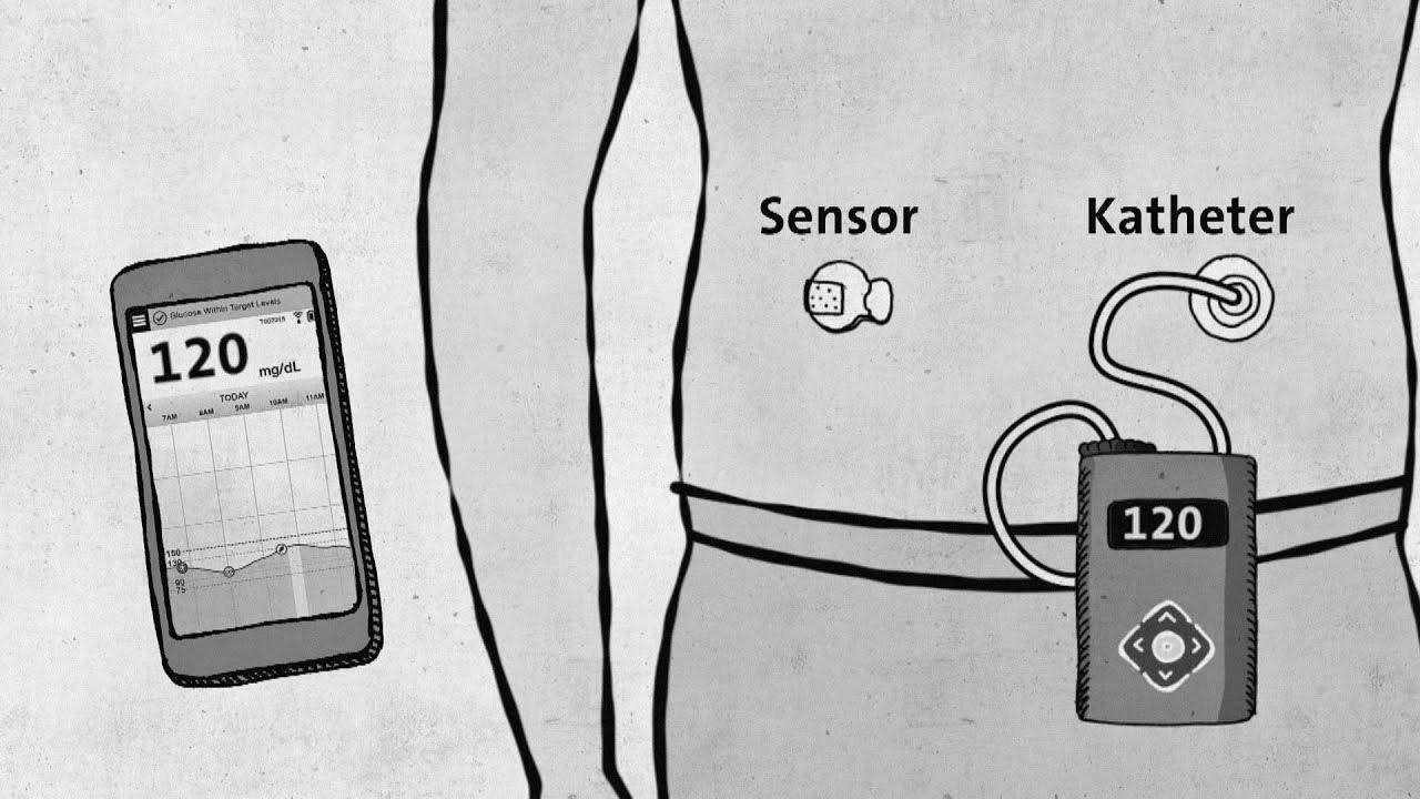 Type 1 diabetes – trendy technology with out approval – good to know